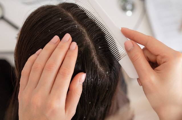Dreaming Of Flake-free Hair? Anti-dandruff Treatment In Mumbai Makes It Possible! | Kosmoderma