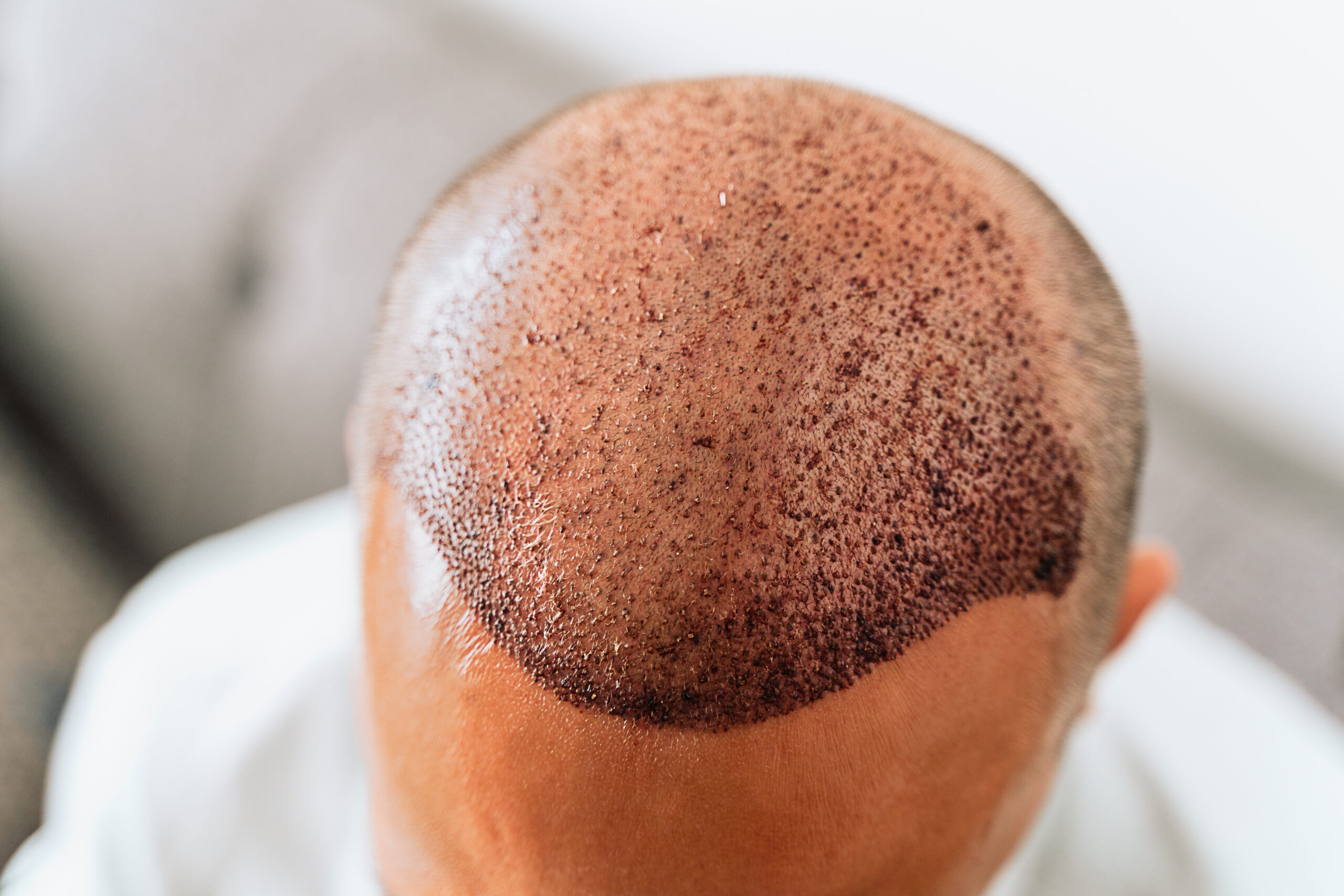 Hair Transplant is Safe: A Complete Guide to Safety, Candidacy, and Results | Kosmoderma