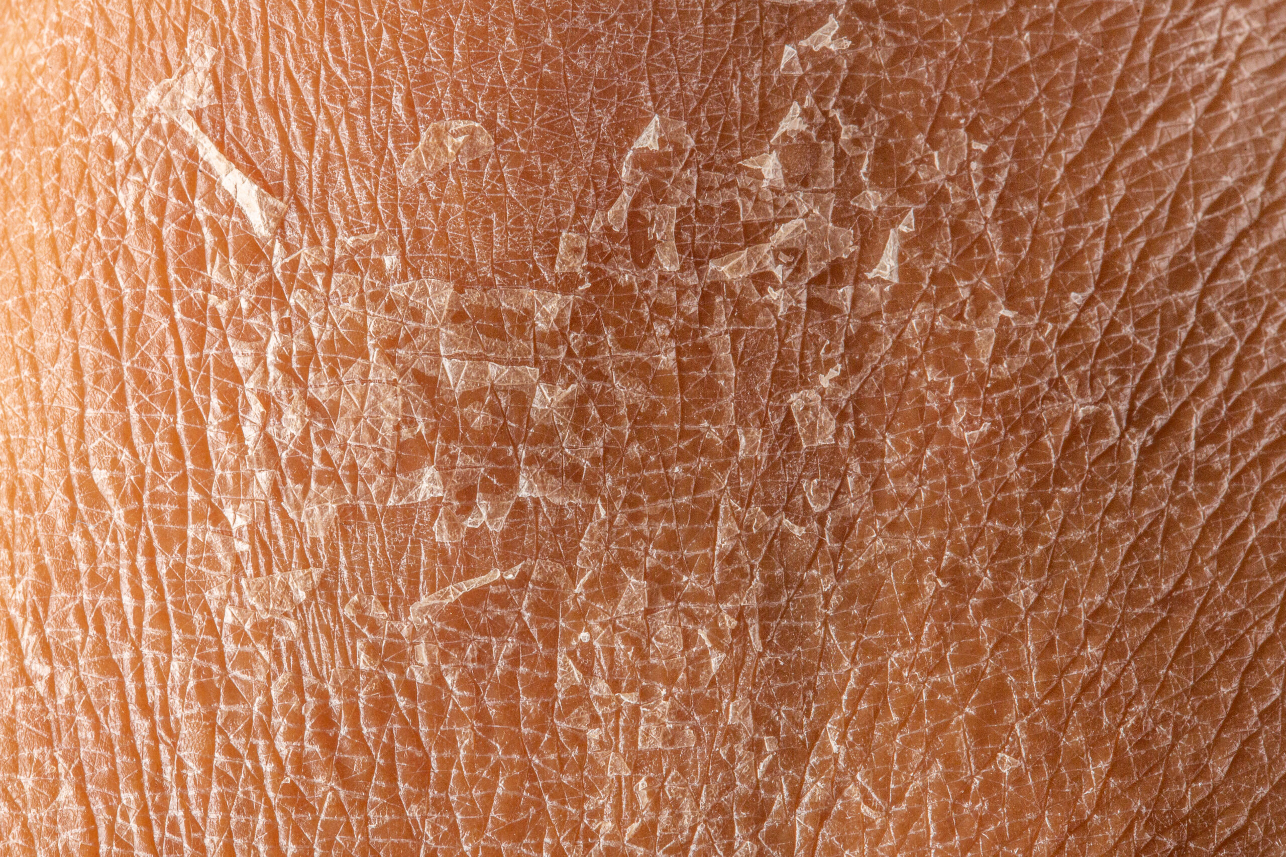 How to Cure Face Dryness in Winter