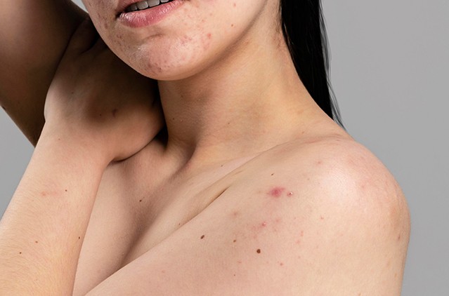 Body Pimples Treatment