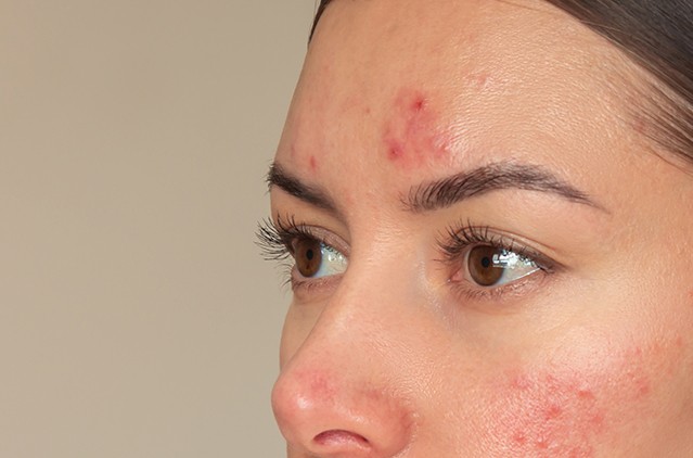 Forehead Pimples Treatment
