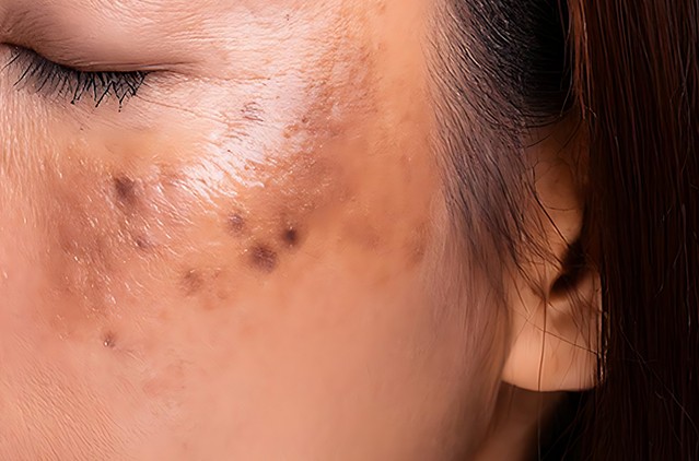 Hyper Pigmentation Treatment: Causes, Cost & Best Options in Bangalore | Kosmoderma