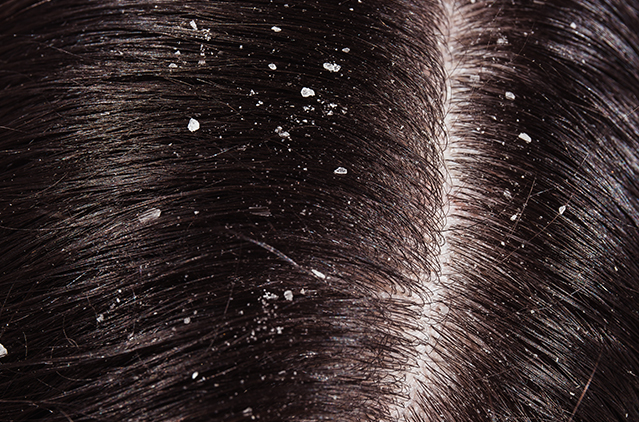 Best Dry Scalp Treatment Guide: Causes, Cures & Prevention | Kosmoderma