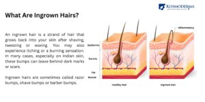 Ingrown Hair Treatment