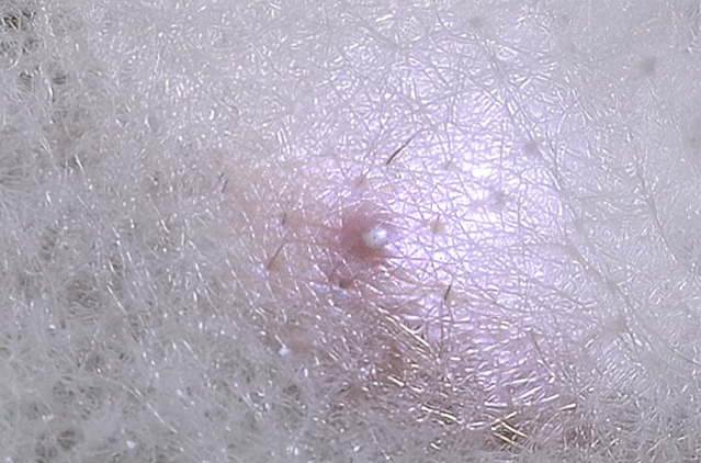 Ingrown hair treatment