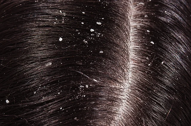 Types of Dandruff: How to Spot Them & Treat Them — Kosmoderma guide | Kosmoderma