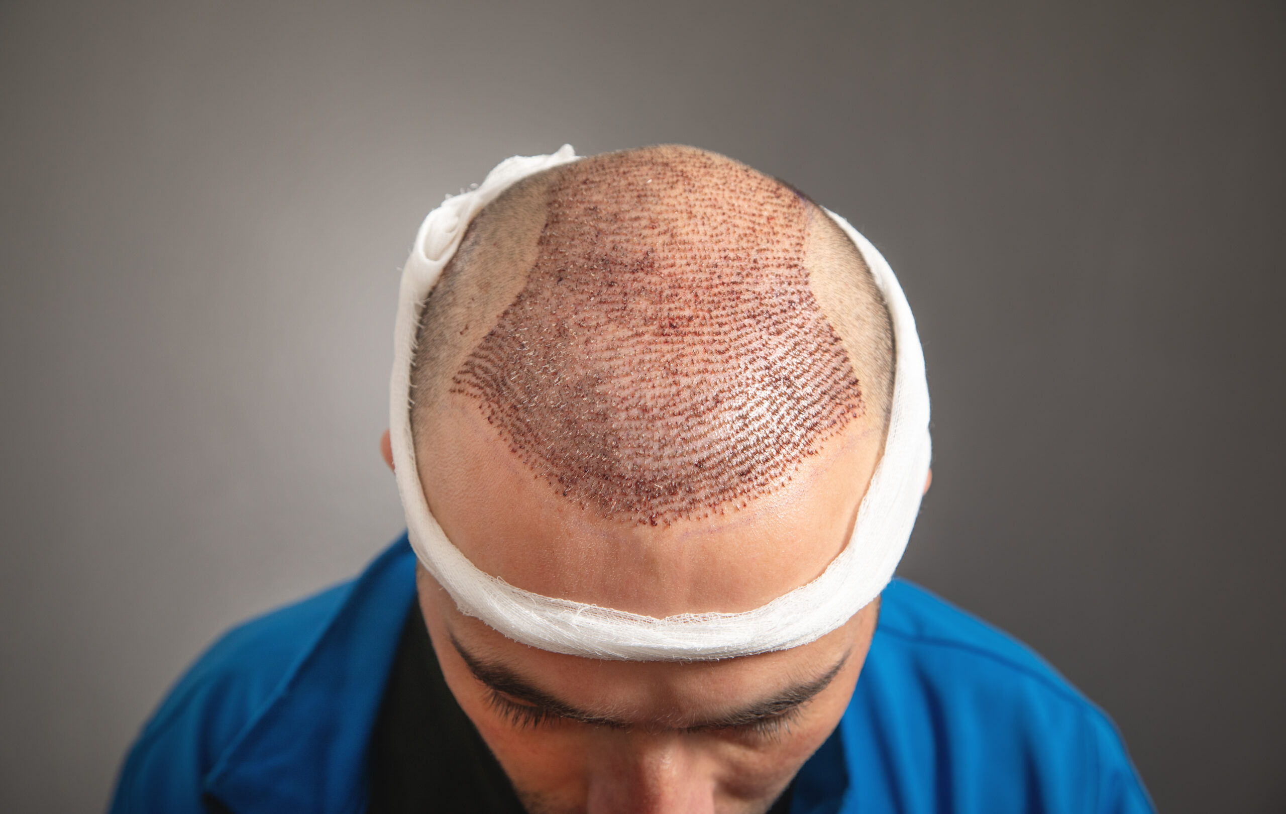 hair transplantation in bangalore