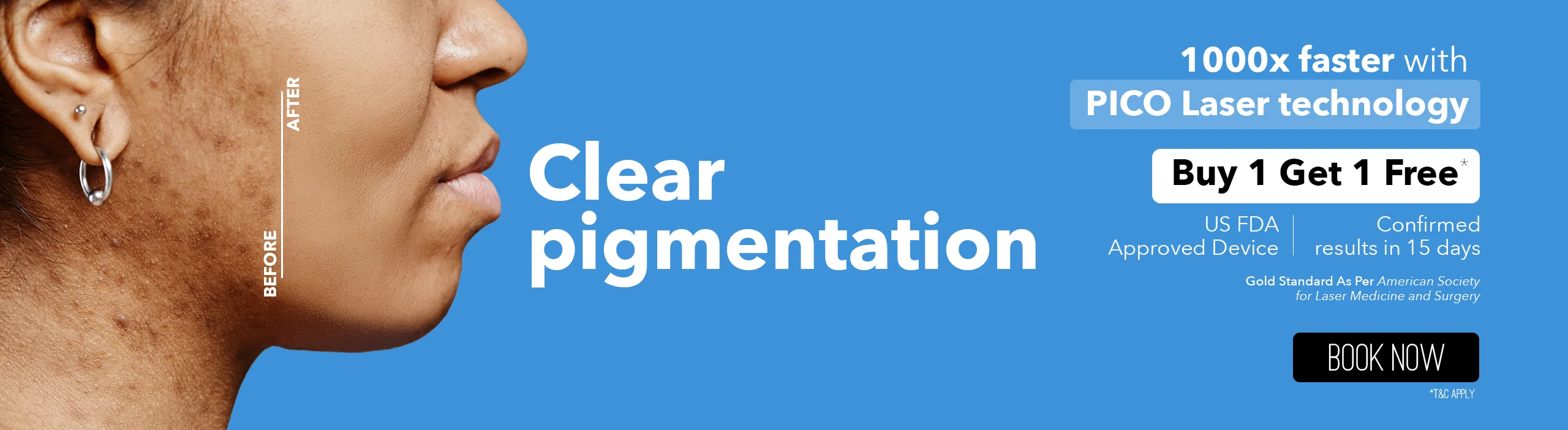 Pigmentation Treatment in Bangalore