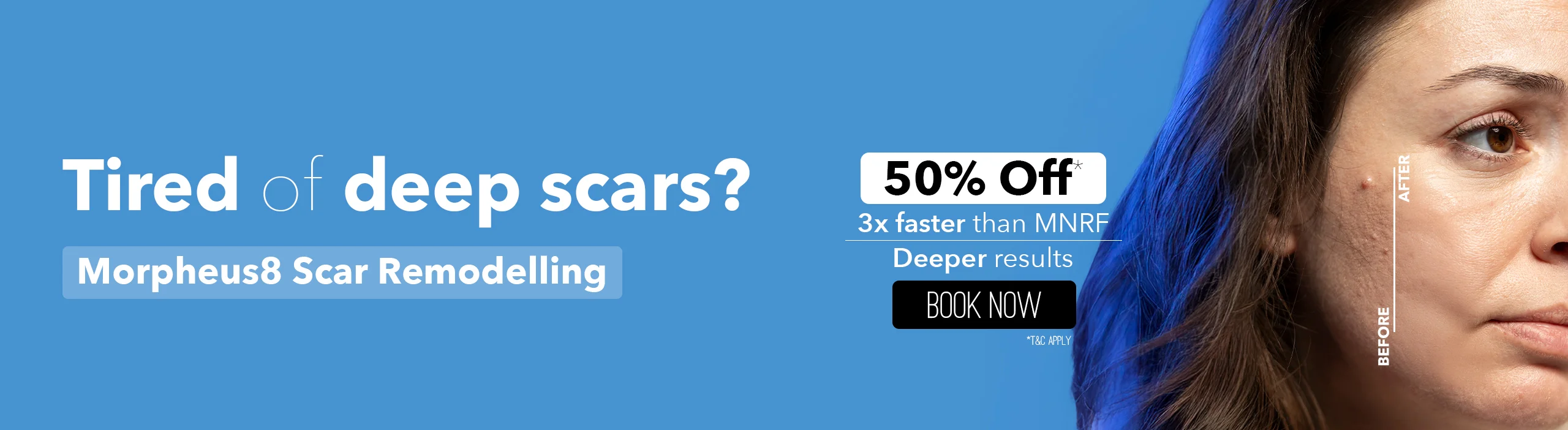 Pico Laser Treatment