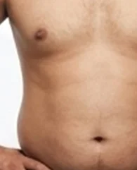 CoolSculpting for abdomen fat reduction for men.