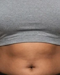 CoolSculpting for abdomen fat reduction for women.