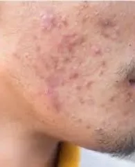 Acne Treatment with Hydrafacial