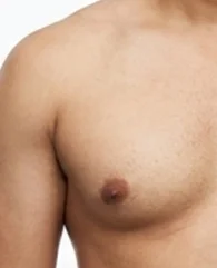 CoolSculpting for localized male chest fat reduction for men.