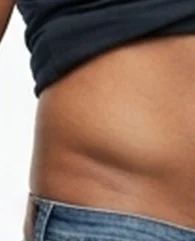 CoolSculpting for flanks and love handles reduction for men.