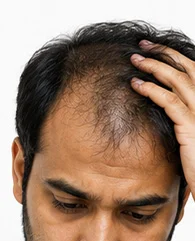IV Drip Therapy for Hair Fall in Men