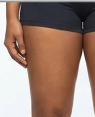 CoolSculpting for inner and outer thigh fat reduction for women.