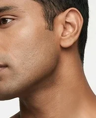 LHR neck hair reduction for men