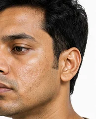 IV Drip Therapy for Poor Skin Texture in Men
