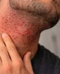 Razor Bumps treatment with hydrafacial
