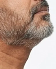 CoolSculpting for submental fat and double chin reduction for men.