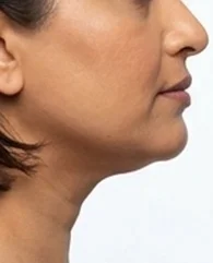 CoolSculpting for double chin reduction for women.