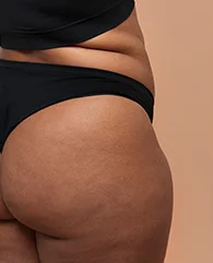 CoolSculpting for banana roll fat reduction for women.