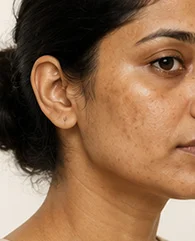 IV Drip for Uneven Skin Tone & Pigmentation
