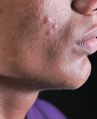 Uneven Skin Tone treatment with Hydrafacial