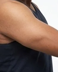 CoolSculpting for upper arm fat reduction for men.