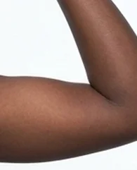 CoolSculpting for upper arm fat reduction for women.