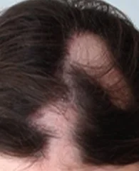 PRP treatment for Alopecia Areata