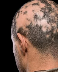 PRP treatment for Alopecia Areata (Patchy Hair Loss)