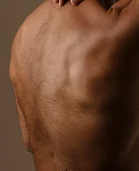 Back and shoulders hair removal with LHR