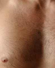 Chest hair removal with laser