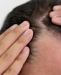 PRP treatment for Diffuse Hair Thinning