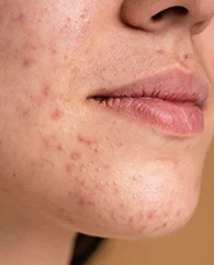 Carbon Laser Peel treatment for acne-prone skin for women.