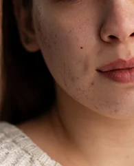 Exosome Therapy for women with acne marks