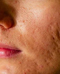 Carbon Laser Peel treatment for acne scars for women.
