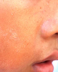 Carbon Laser Peel treatment for dullness and rough skin texture for women.