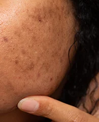 Carbon Laser Peel treatment for pigmentation and uneven skin tone for women.