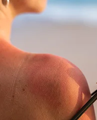 Carbon Laser Peel treatment for sun-damaged skin for women.