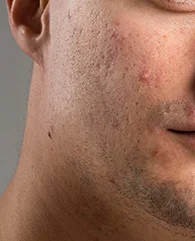Carbon Laser Peel treatment for acne for men.