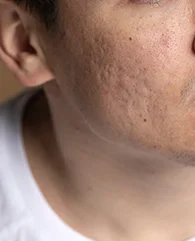 Exosome Therapy for acne scars