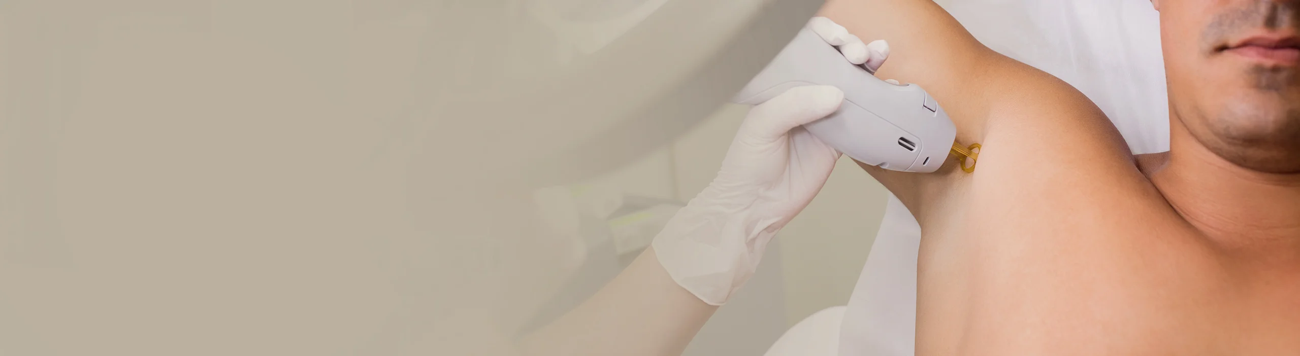 Laser hair removal for male