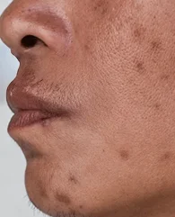 Carbon Laser Peel treatment for dark spots for men.