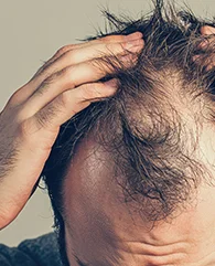 Exosome Therapy for hair loss