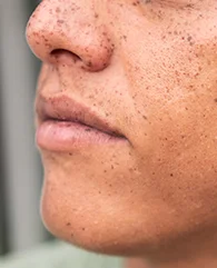 Carbon Laser Peel treatment for pigmentation for men.