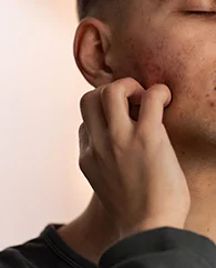 Exosome Therapy for rough skin texture