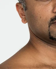 Carbon Laser Peel treatment for uneven skin texture for men.