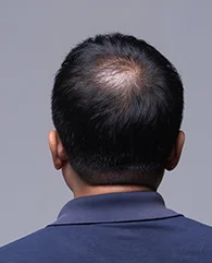 PRP treatment for Male Pattern Baldness (Androgenetic Alopecia)